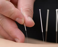 Acupuncture